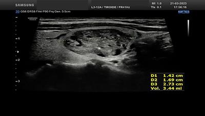 Recurrent laryngeal nerve monitoring by flexible laryngoscopy during thyroid radiofrequency ablation in the awake patient